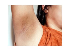 زردی عرق زیر بغل